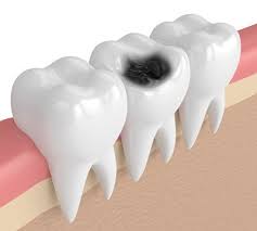 sâu răng nguyên nhân và cách điều trị