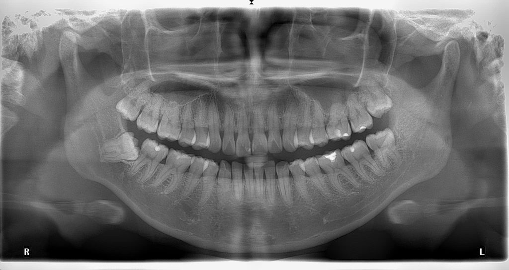 nhổ răng khôn không đau tại Nha khoa 360 Dental
