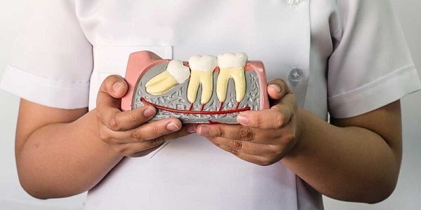 răng khôn là gì có cần thiết nhổ răng khôn