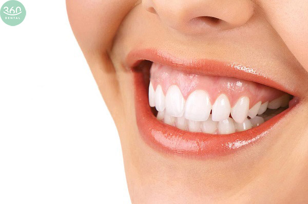 Tiểu phẫu chữa cười hở lợi tại Nha khoa 360 Dental