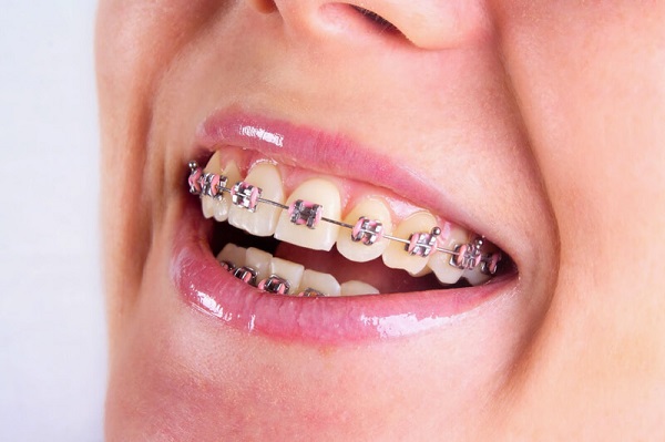 Niềng răng tại Nha khoa 360 Dental