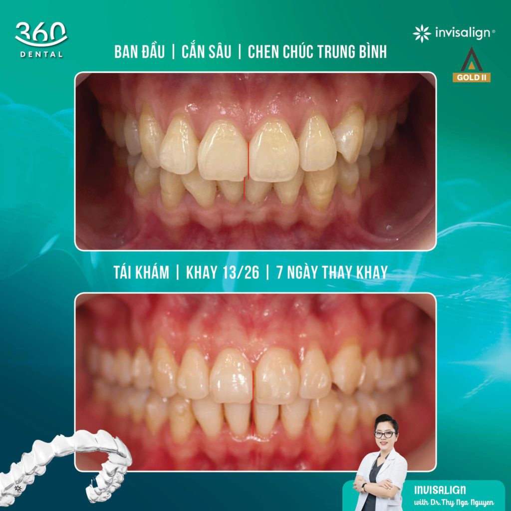 Niềng răng Invisalign tại Nha khoa 360 Dental