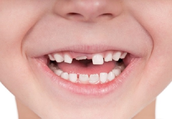 Chữa răng trẻ em tại Nha khoa 360 Dental