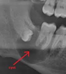 chụp phim nang thân răng biến chứng răng khôn