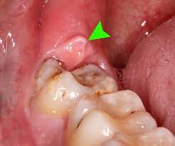 hình ảnh viêm lợi trùm biến chứng nhổ răng khôn