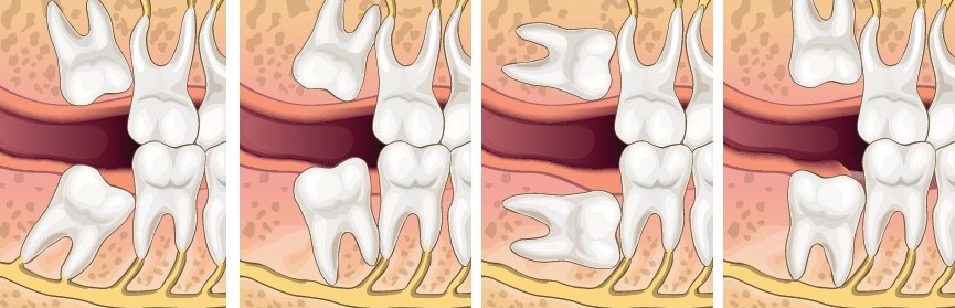 minh họa các kiểu răng khôn mọc nghiêng