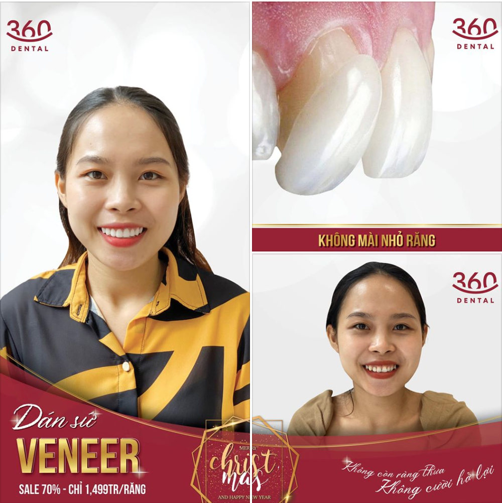 Khách hàng thẩm mỹ răng sứ tại Nha khoa 360 Dental