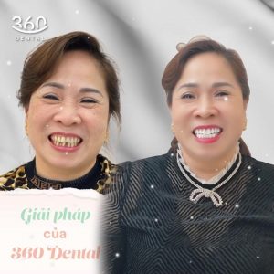 Khách hàng thẩm mỹ răng sứ tại Nha khoa 360 Dental