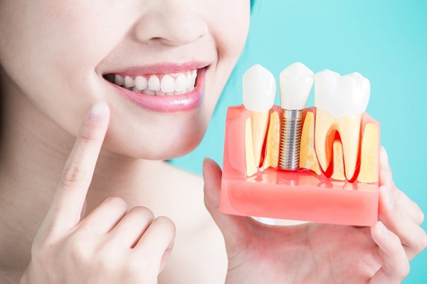 Cấy implant tại Nha khoa 360 Dental