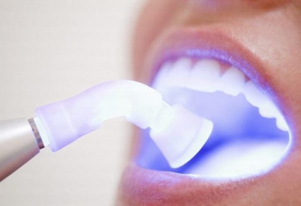 Tẩy trắng răng tại Nha khoa 360 Dental