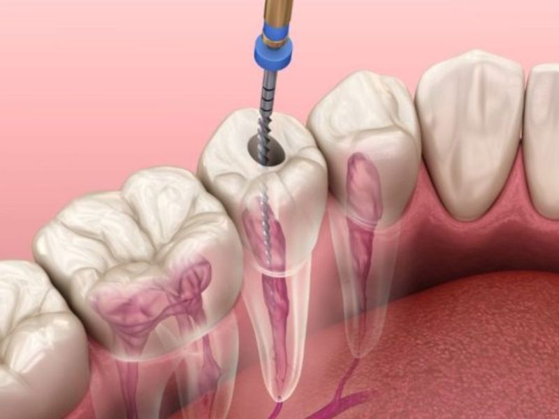 Khi nào phải điều trị tủy răng?